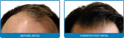 precision medical hair restoration & aesthetics|hair transplant new mexico.